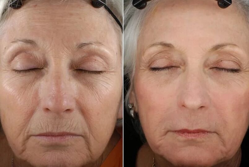 Fractionary rejuvenation results