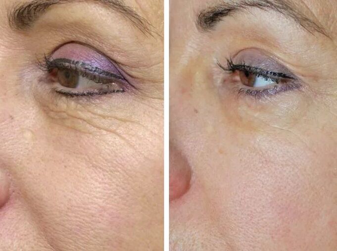 Laser of land before and after