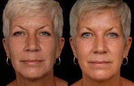 woman face before and after